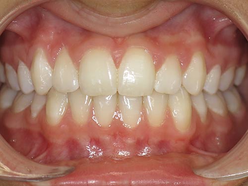 CROWDING EXTRACTIONS AFTER