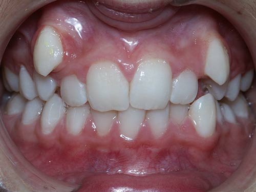CROWDING EXTRACTIONS BEFORE
