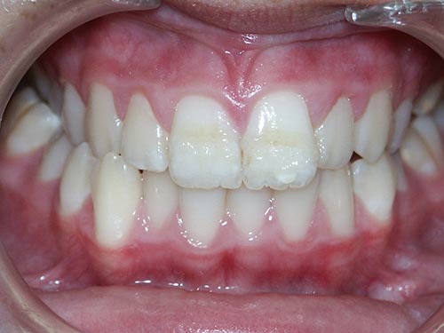 EXPANSION 1 PRE TREATMENT