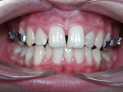 EXPANSION 2 END PHASE 1