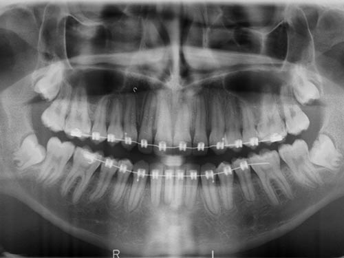 IMPACTED CANINE FINAL