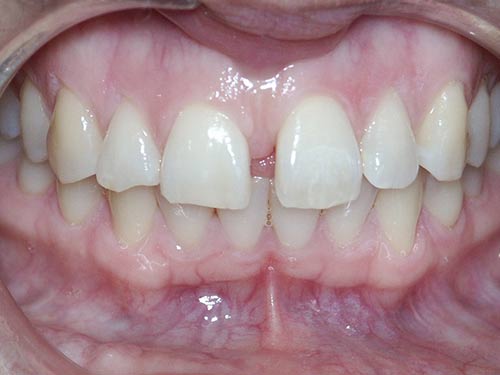INVISALIGN BEFORE